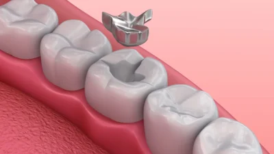 Diş dolgularında uzun yıllardır kullanılan amalgam materyaline ilişkin tartışmalar sürerken,