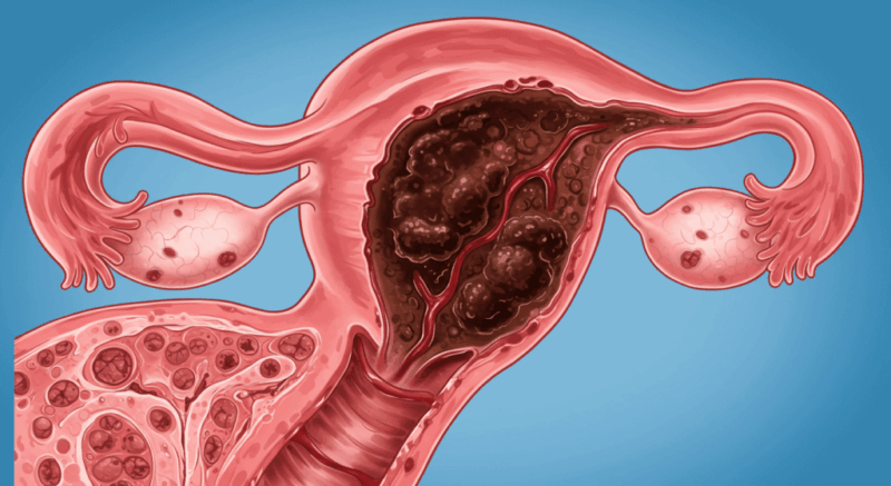 Halk arasında “çikolata kisti” olarak bilinen endometriozisin, her 10 kadından